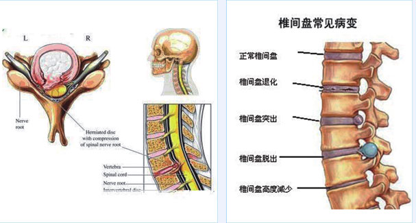 腰椎间盘突出