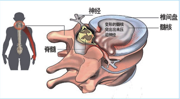 腰椎间盘突出不需手术