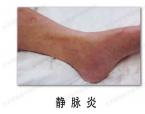 静脉炎的症状表现有哪些?