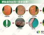 深静脉血栓怎么治