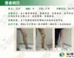静脉炎的治疗