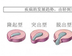 手麻脚麻不可忽视,警惕腰椎病惹的祸