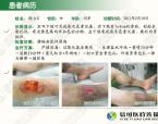 老烂腿临床分级