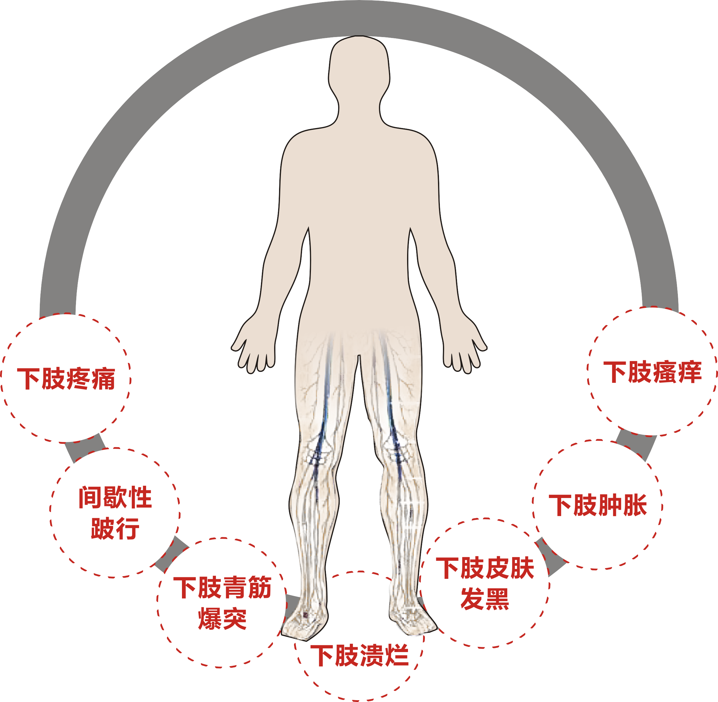 静脉曲张到老烂腿变化图