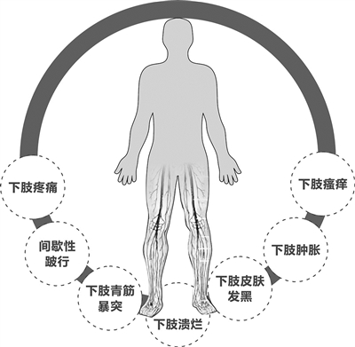 静脉曲张