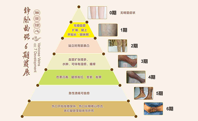 糖尿病足早、中期就没有办法？