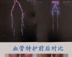 柳氏血管专护